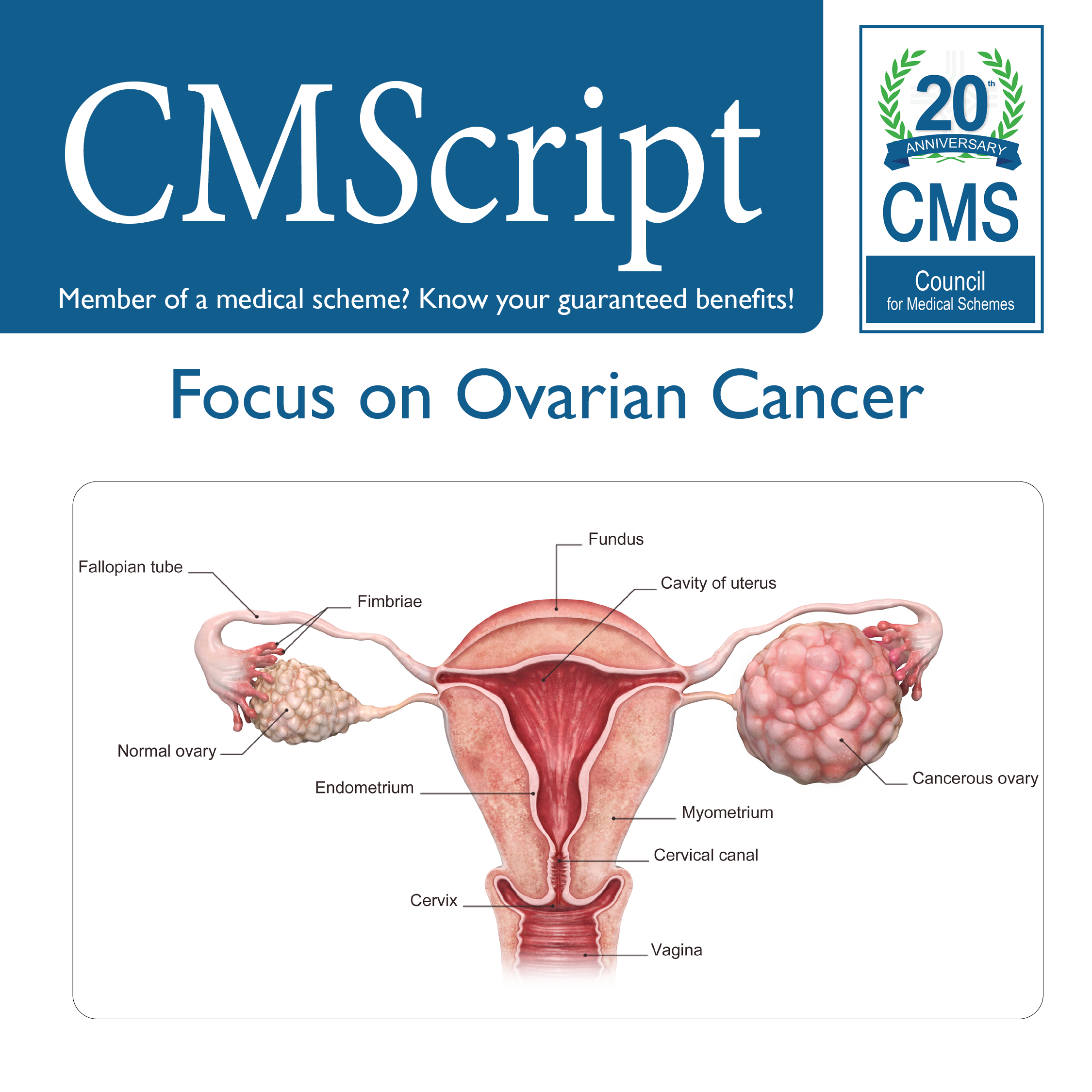 ovarian cancer